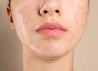 Acnee hormonală – Sfaturi și recomandări Acnee hormonală - Sfaturi și recomandări