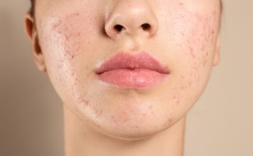 Acnee hormonală – Sfaturi și recomandări Acnee hormonală - Sfaturi și recomandări
