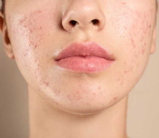 Acnee hormonală – Sfaturi și recomandări Acnee hormonală - Sfaturi și recomandări