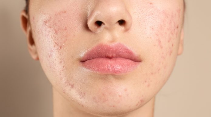 Acnee hormonală – Sfaturi și recomandări Acnee hormonală - Sfaturi și recomandări