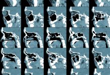 3 afecțiuni ale sinusurilor ce pot fi depistate în urma unui CT 3 afecțiuni ale sinusurilor ce pot fi depistate în urma unui CT