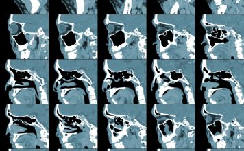 3 afecțiuni ale sinusurilor ce pot fi depistate în urma unui CT 3 afecțiuni ale sinusurilor ce pot fi depistate în urma unui CT