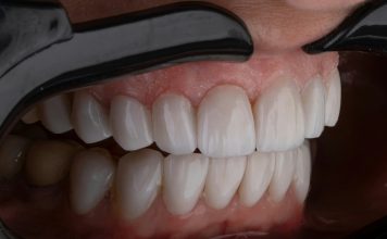 Tratamente moderne pentru reconstrucția dinților în București Tratamente moderne pentru reconstrucția dinților în București